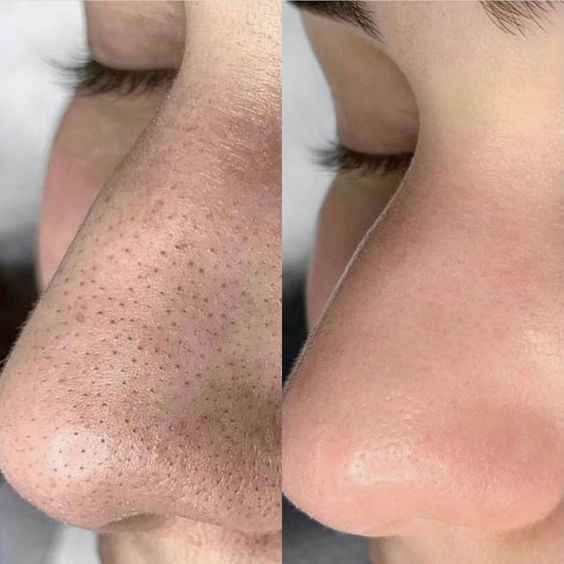 Anti Acne Milky Cleanser - 100ML