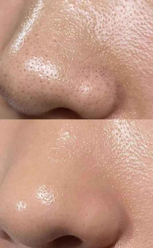 Anti Acne Milky Cleanser - 100ML