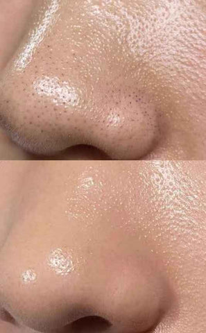 Anti Acne Milky Cleanser - 100ML